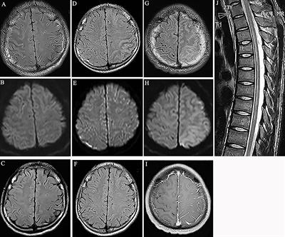 The Clinical Features of FLAIR-Hyperintense Lesions in Anti-MOG Antibody Associated Cerebral Cortical Encephalitis with Seizures: Case Reports and Literature Review